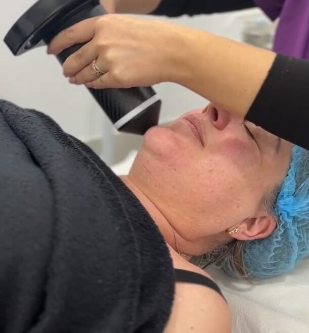 Radiofrecuencia en Xanara Laser: Renueva tu Piel sin Cirugía